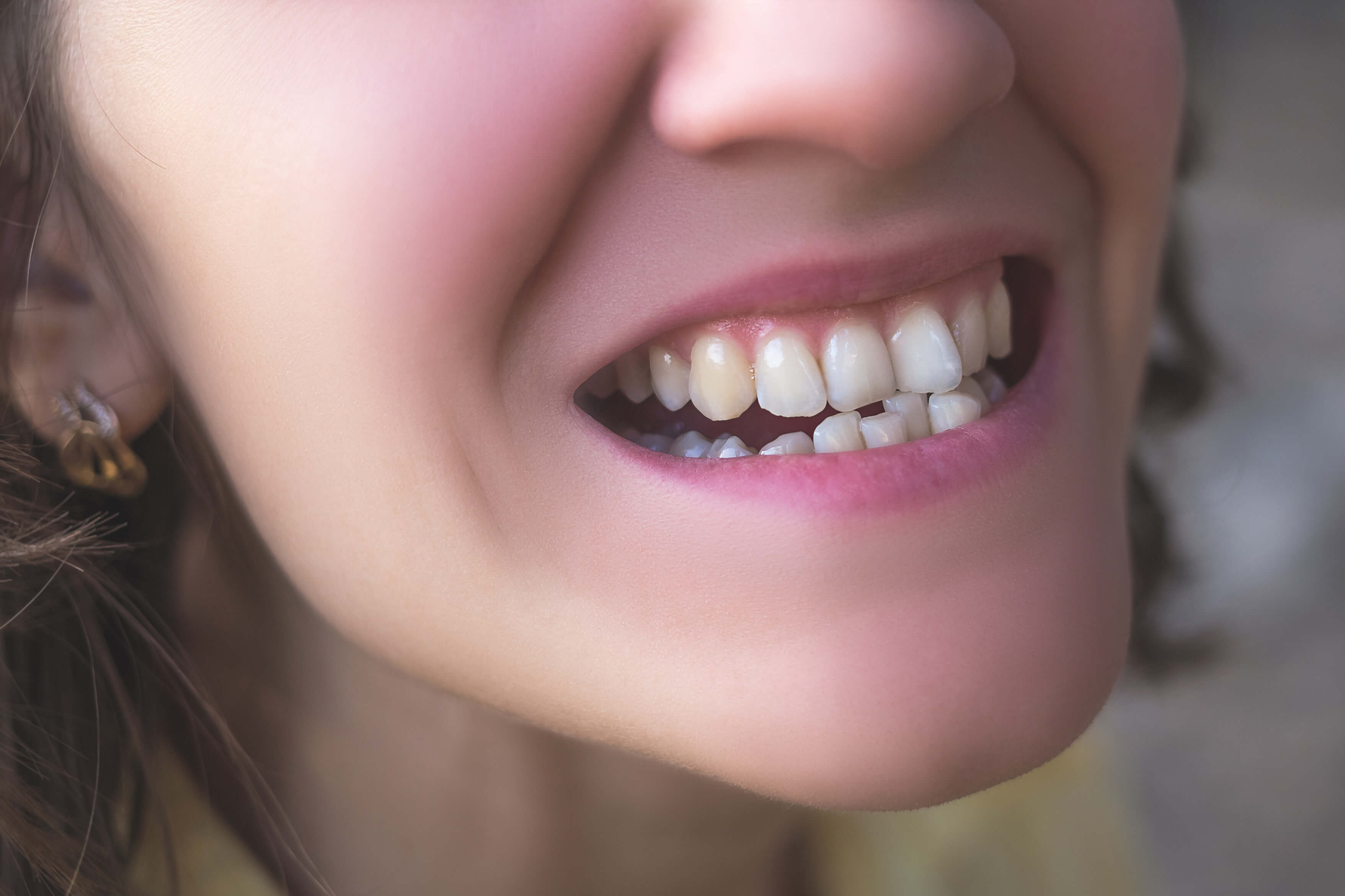 Crooked Teeth Causes And Treatment Options Ismile Specialists